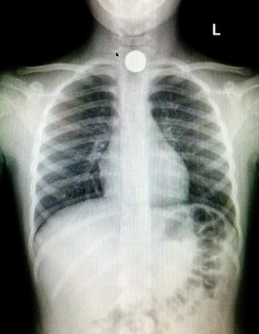 button battery ingestion attorney button battery ingestion attorney
